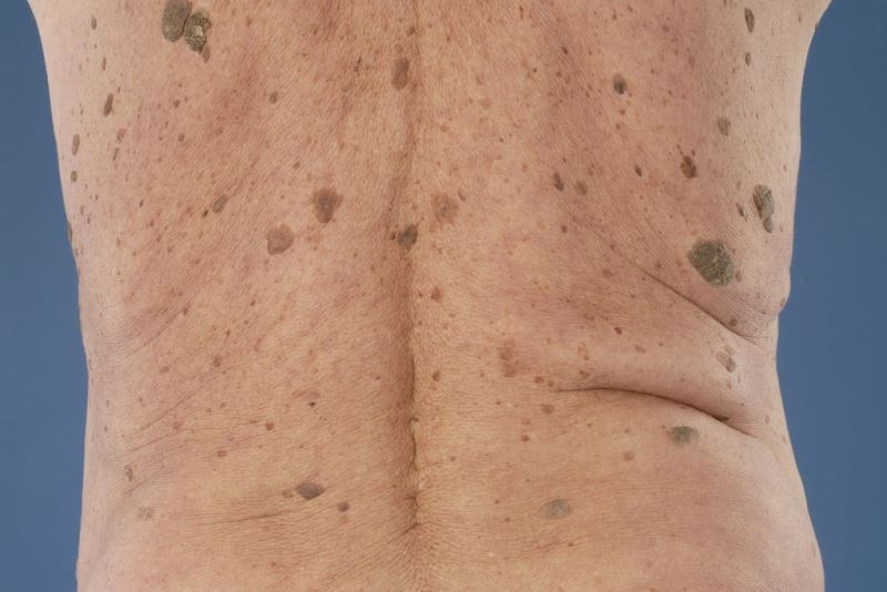 Кератоз кожи на спине