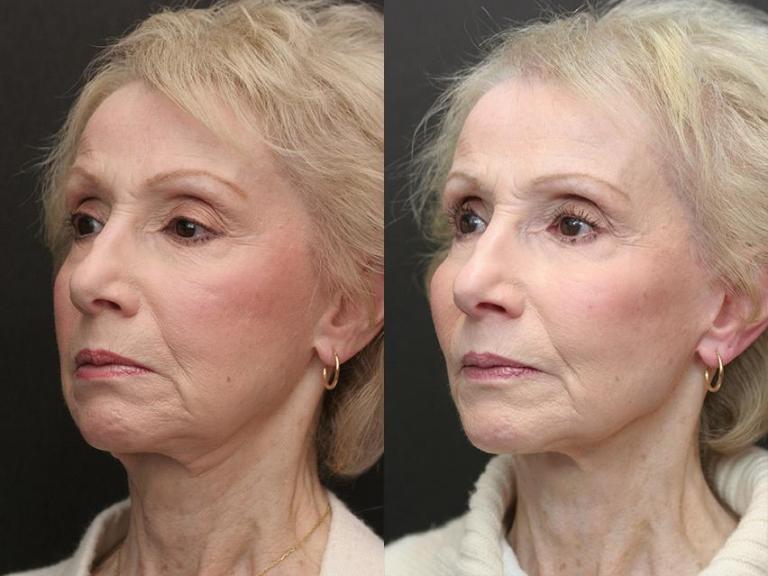 Фото до и после неинвазивного липолиза на подбородке