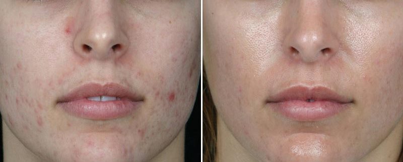 Дезинкрустация лица