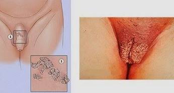 хламидиоз фото