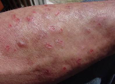 хламидиоз у мужчин фото