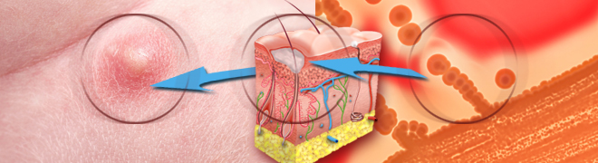 Что делать когда вскрылся фурункул