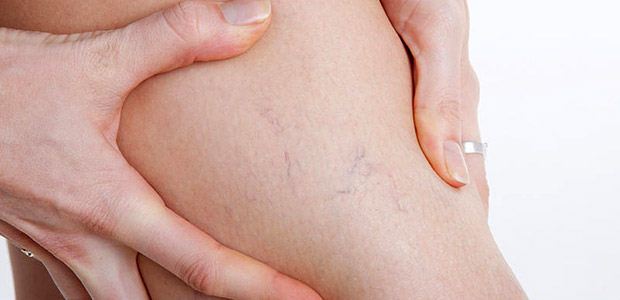 предвесники варикоза на ногах