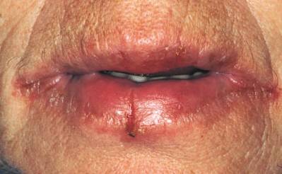 контактный аллергичский хейлит фото