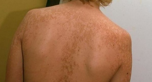 cvetnoj-lishaj-na-kozhe-lechenie-foto