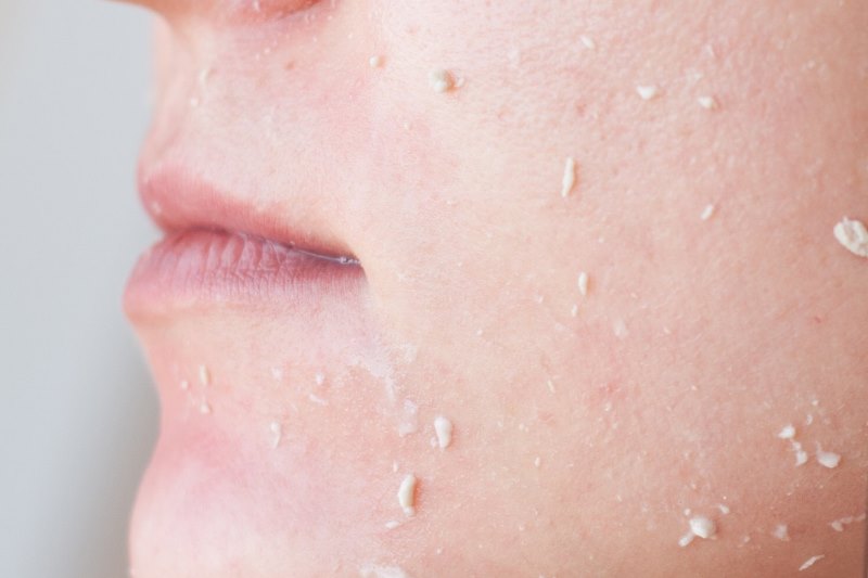 Пилинг скатка Пропеллер на лице