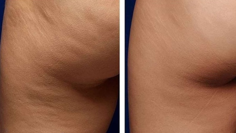 До и после дарсонвализации