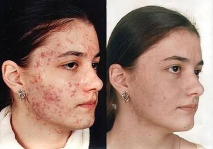 demodekoz-lechenie-na-lice-foto