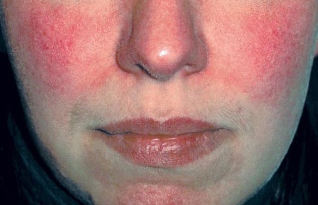 demodekoz-lechenie-na-lice