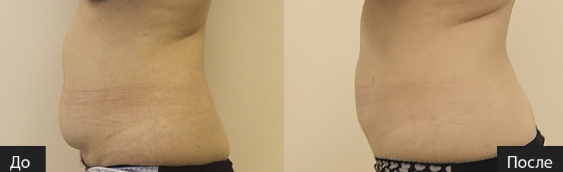 Лазерная липосакция живота фото до и после