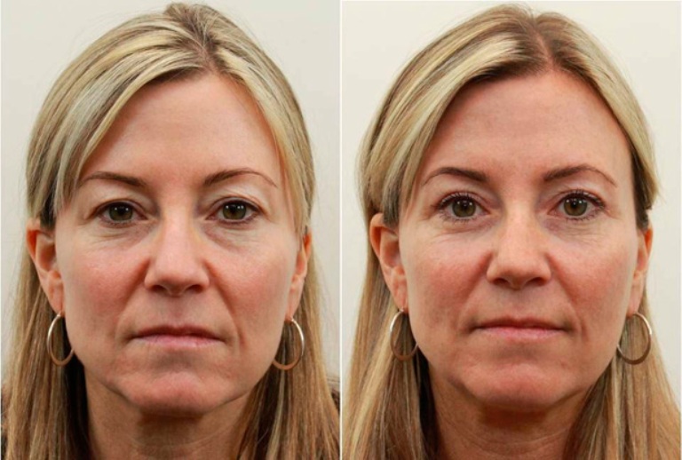 Фото до и после аквашайн биоревитализации