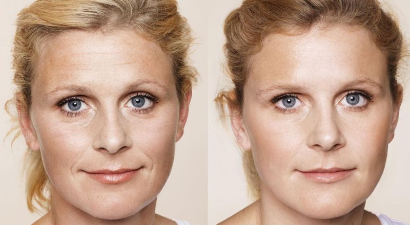 Контурная пластика до и после