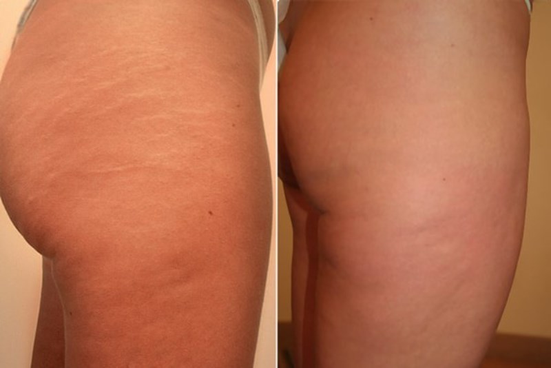 Фото до и после прессотерапии