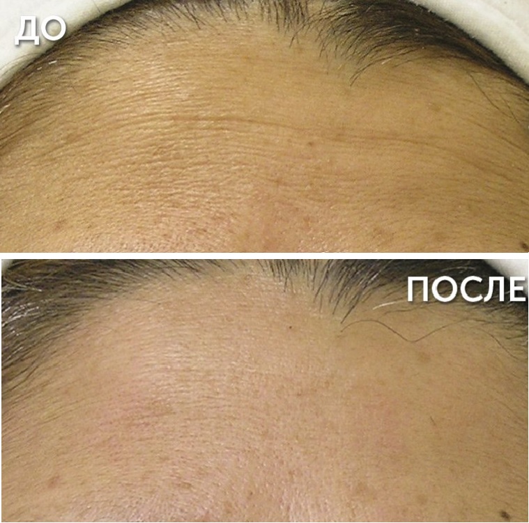 Процедура HydraFacial: фото до и после