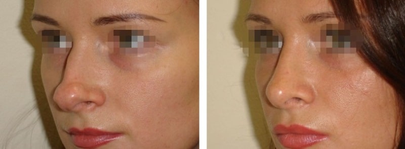 ринопластика до и после