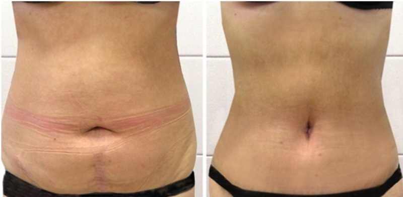 Душ Шарко: отзывы, фото до и после