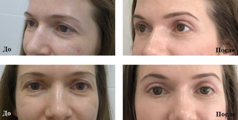 До и после блефаропластики