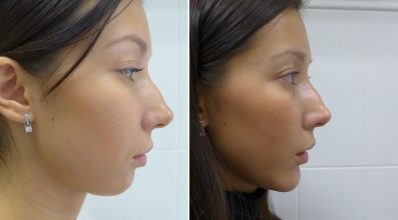 Девушка до и после ментопластики от Михайлова