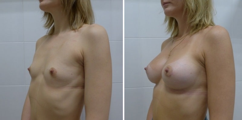 До и после маммопластики