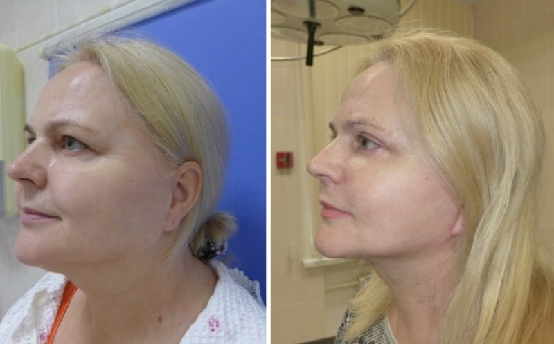 отзыв о смас лифтинге с фото до и после