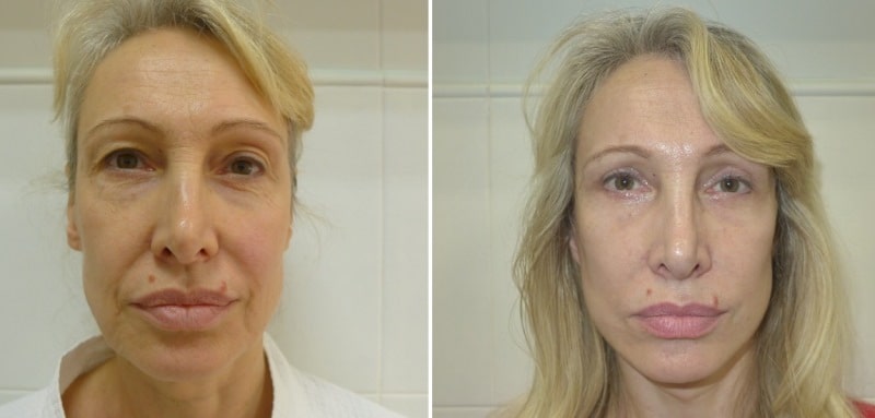 смас лифтинг отзыв с фото до и после