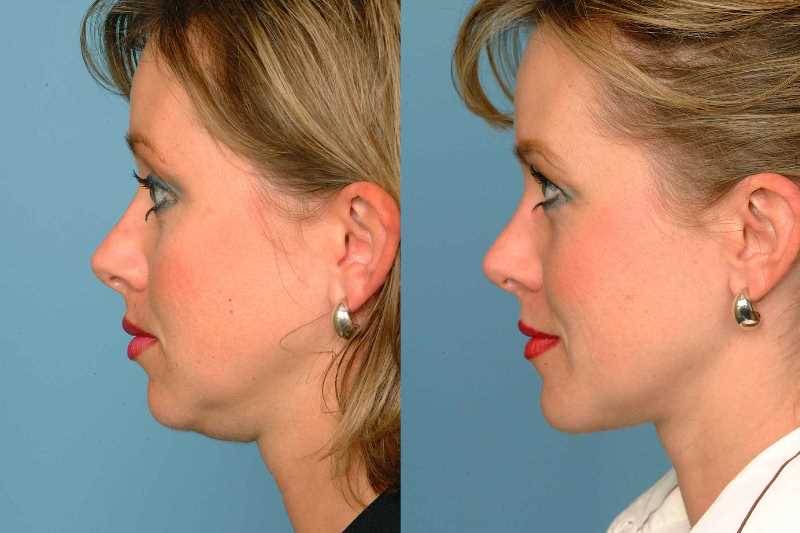 Липосакция подбородка: фото до и после