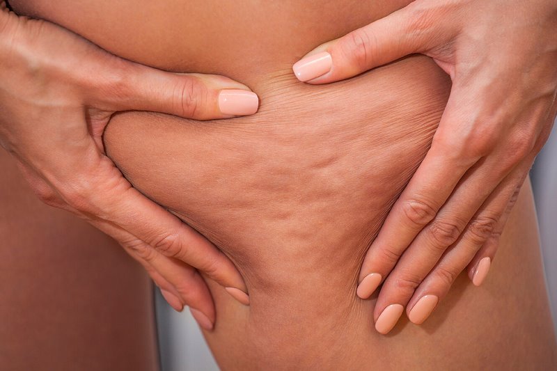 Признаки целлюлита