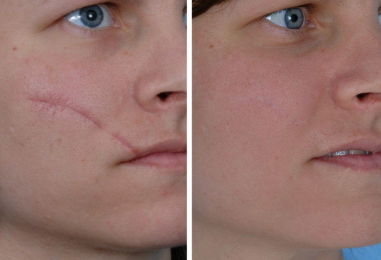 Фото до и после липофилинга лица