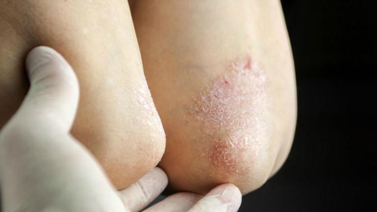 Экзема сухая