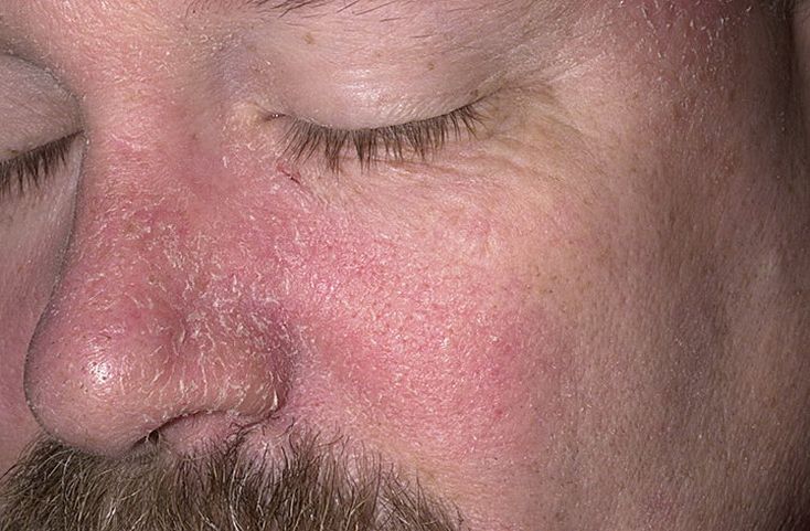 экзема на лице