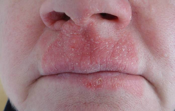 Экзематозный хейлит фото