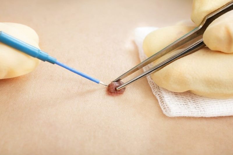 Что такое электрокоагуляция, как проводится