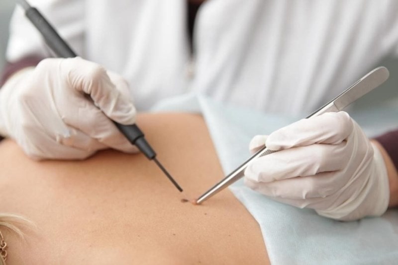 Проводится электрокоагуляция