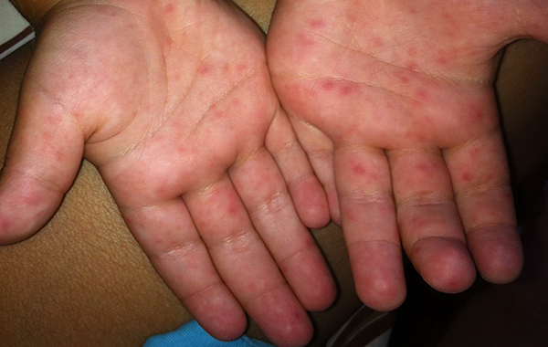 enterobirusnaya-infekciya