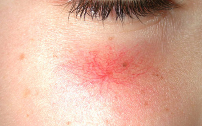 купероз признаки