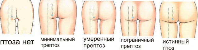 схема градации птоза
