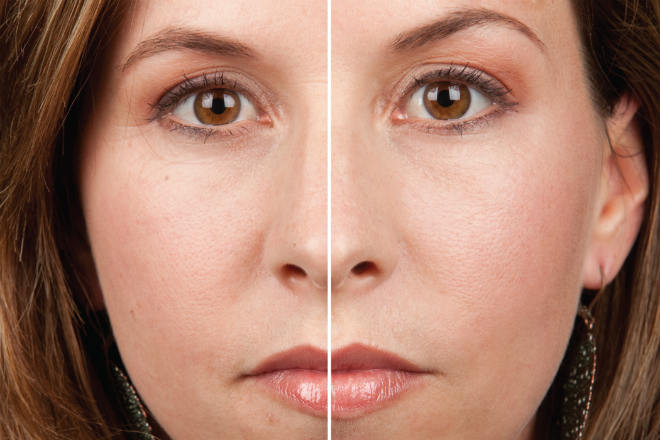 солкосерил фото до и после