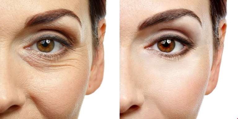 Фото до и после коррекции век