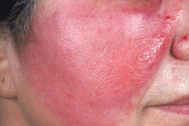 Рожистое воспаление лица на фото