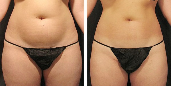 липосакция живота до и после