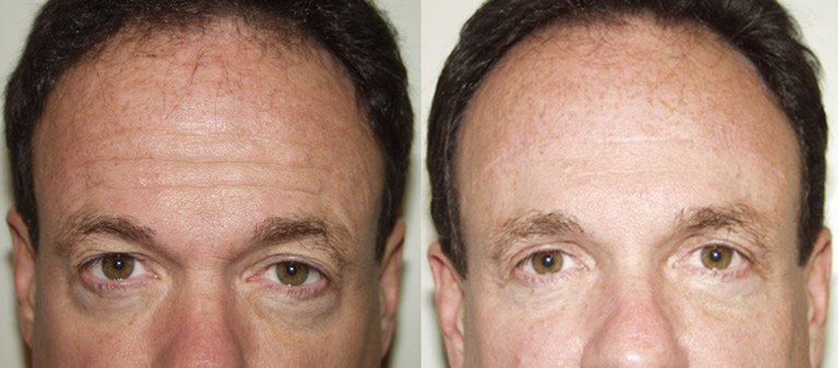 мужчина лоб фото до и после Ботокса