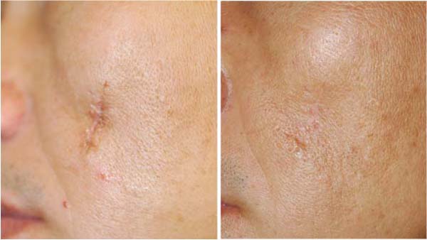 Какое средство от рубцов от прыщей самое эффективное