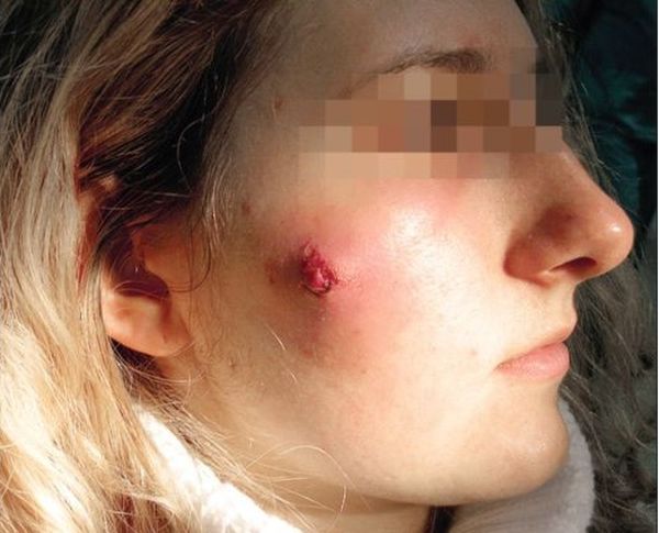 Что делать когда вскрылся фурункул