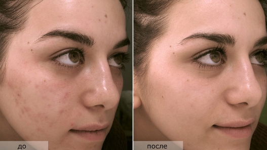 лицо девушки после пилинга фото до и после