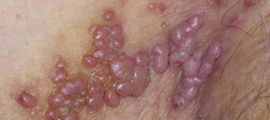 генитальный герпес у мужчин фото