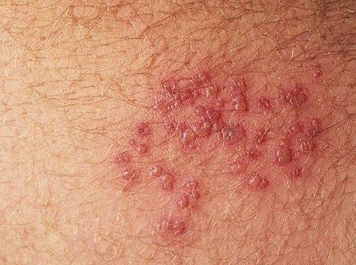 генитальный герпес высыпания фото