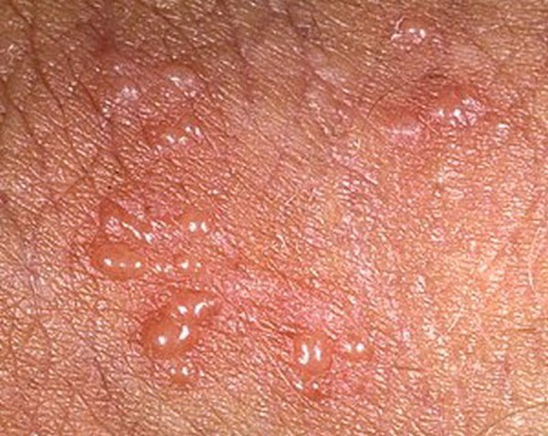 Почему появляются прыщи в паху у мужчин - причины и лечение