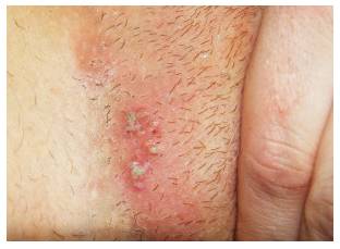 gerpes-v-intimnoj-zone-foto-1