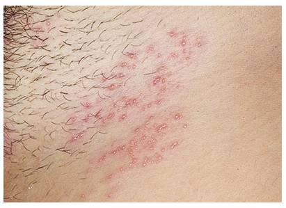 gerpes-v-intimnoj-zone-foto-2