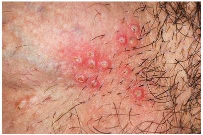 gerpes-v-intimnoj-zone-foto